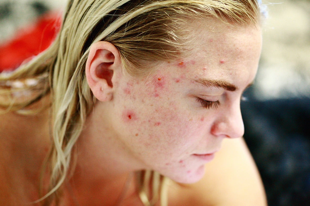 Shilajit for Acne: Can It Prevent Breakouts?